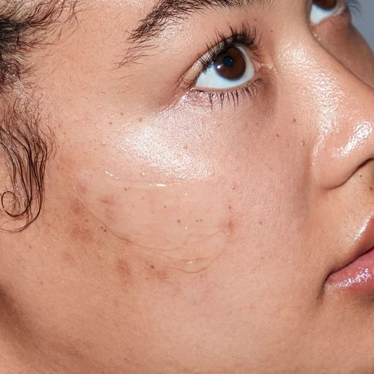 Acne Facial - For All Types & Stages of Acne