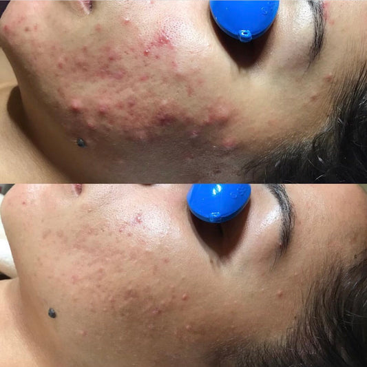 Acne Facial - For All Types & Stages of Acne